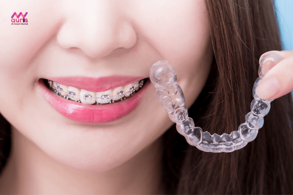 Phương pháp niềng răng - Các yếu tố tác động đến chi phí niềng răng 