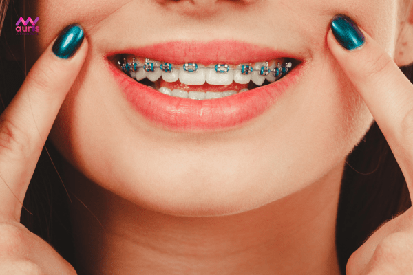 Chất lượng khí cụ chỉnh nha - Các yếu tố tác động đến chi phí niềng răng 