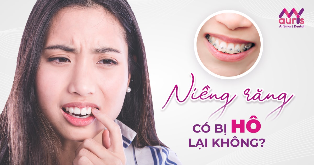 Niềng răng có bị hô lại không? - Từ 4 nguyên nhân chính