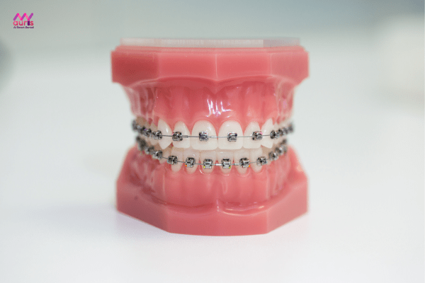 Kỹ thuật chỉnh nha sai, vật liệu chỉnh nha không chất lượng - Nguyên nhân niềng răng có bị hóp má