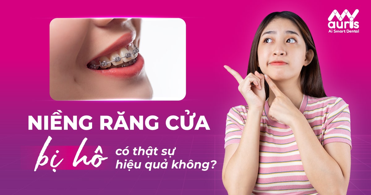 Niềng răng cửa bị hô có thật sự hiệu quả không?