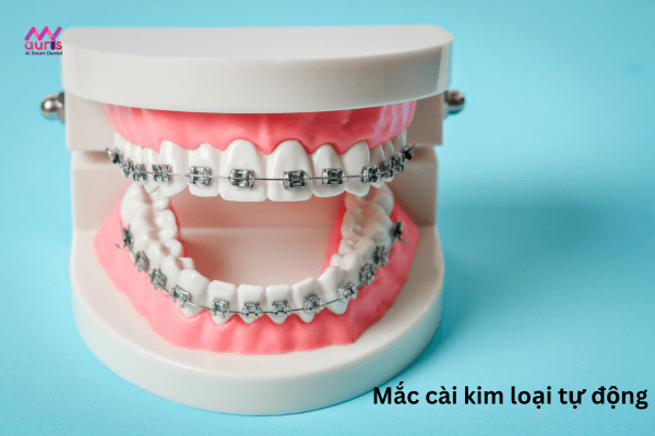 Niềng răng cửa bị mọc lệch bằng mắc cài kim loại 