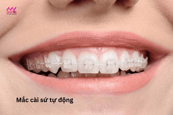 Niềng răng cửa bị lệch bằng mắc cài sứ/ pha lê