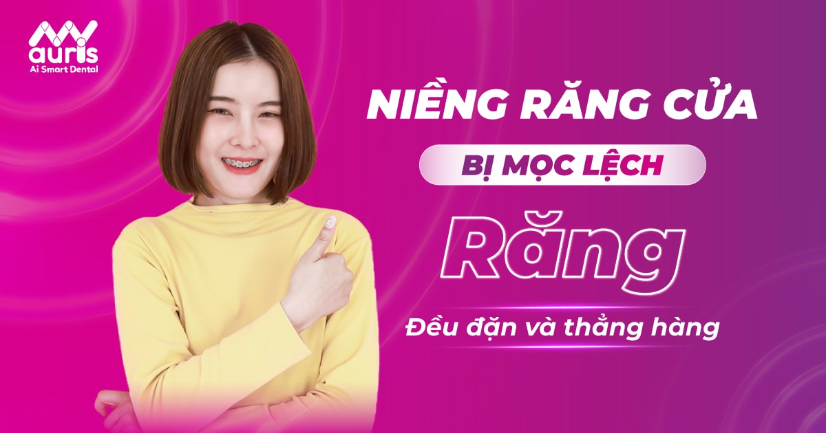 Niềng răng cửa bị mọc lệch