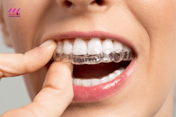 Phương pháp niềng răng cửa bị thưa bằng khay niềng trong suốt