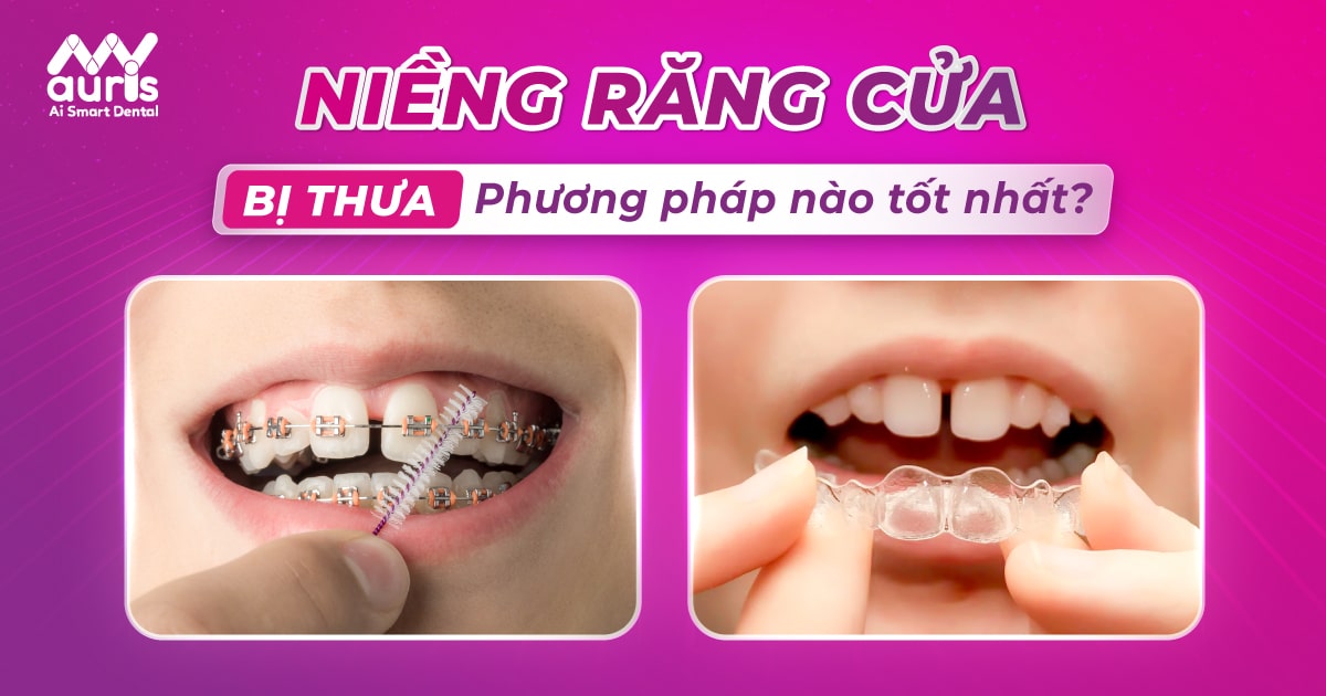 Niềng răng cửa bị thưa