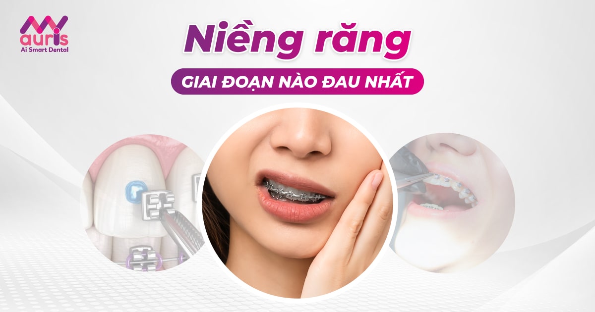 Niềng răng giai đoạn nào đau nhất? (Chi tiết 6 giai đoạn)