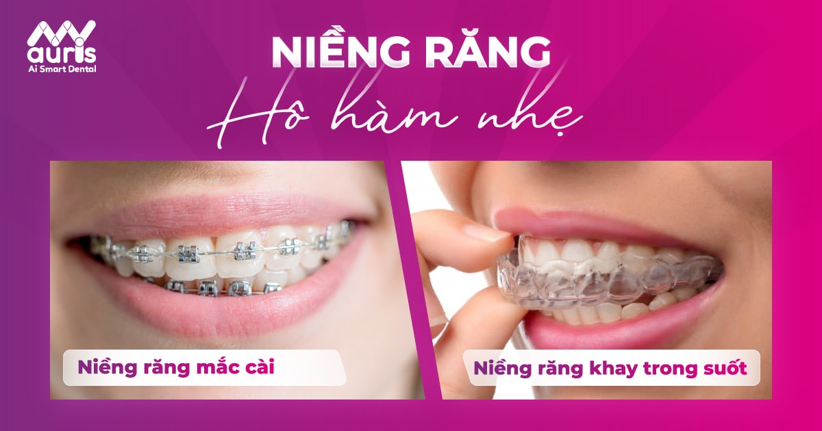 Niềng răng hô hàm nhẹ được không? (2 kỹ thuật thực hiện)