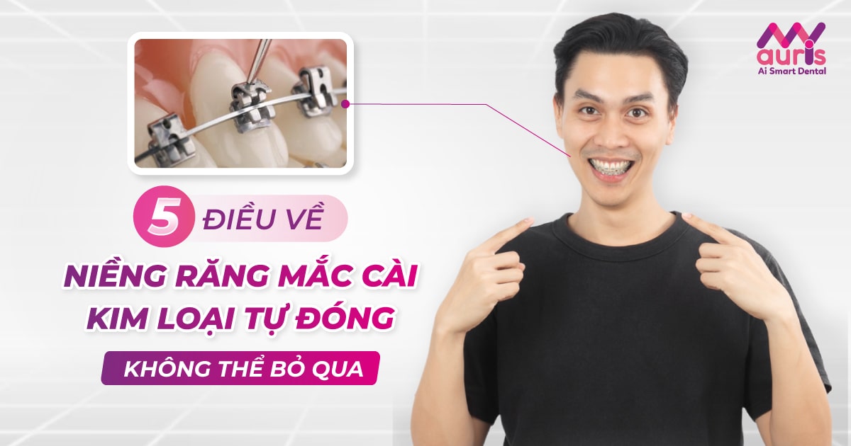 niềng răng mắc cài kim loại tự đóng