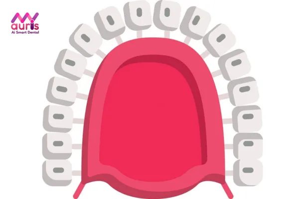 Niềng răng mắc cài trong hàm là phương pháp gì?