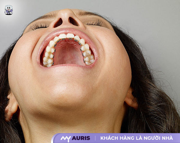 niềng răng mặt lưỡi, niềng răng mặt trong