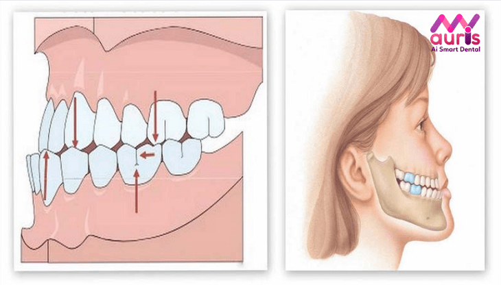 niềng răng tháo lắp mức 3