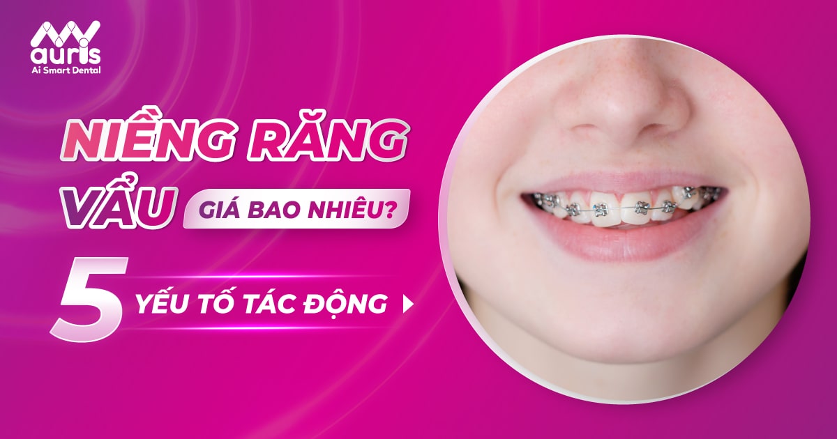 Niềng răng vẩu giá bao nhiêu