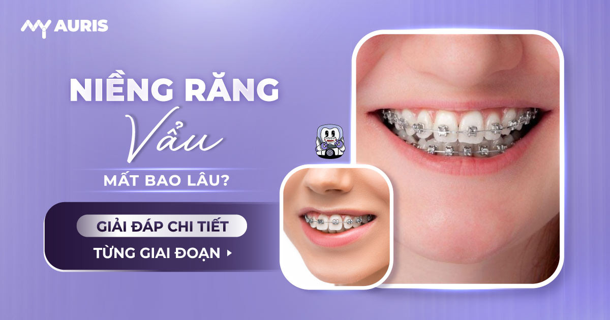 niềng răng vẩu mất bao lâu