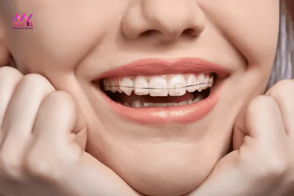Niềng răng hô vẩu trung bình mất bao lâu? 