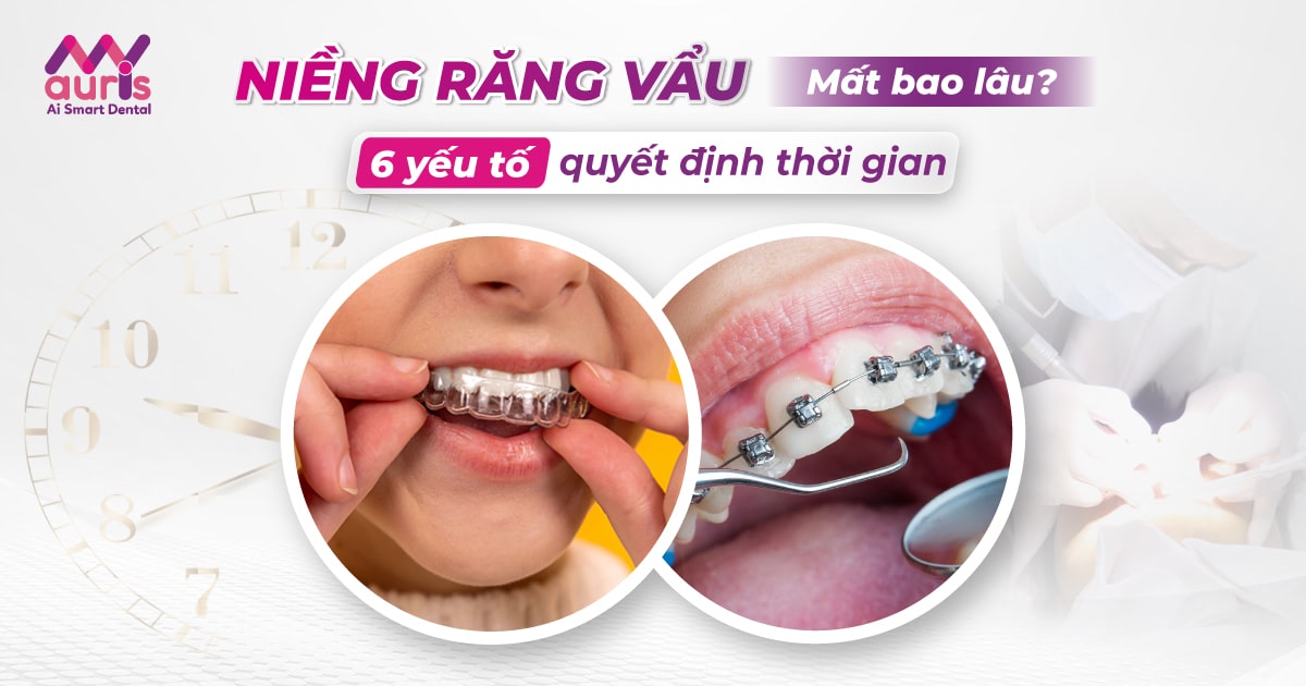 Niềng răng vẩu mất bao lâu