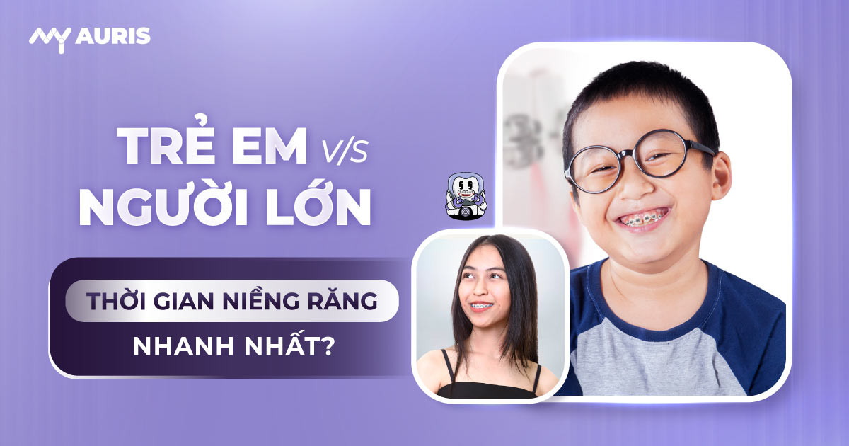 thời gian niềng răng nhanh nhất là bao lâu
