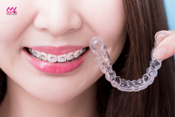 Phương pháp chỉnh nha - Thời gian niềng răng bao lâu phụ thuộc các yếu tố nào?