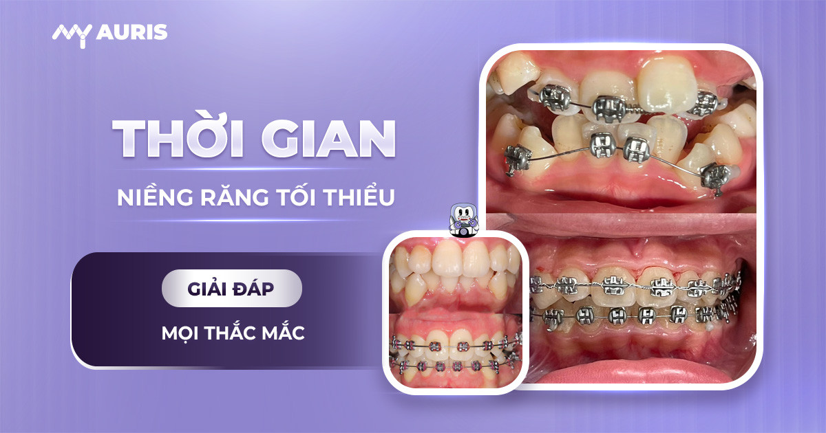 Thời gian niềng răng tối thiểu