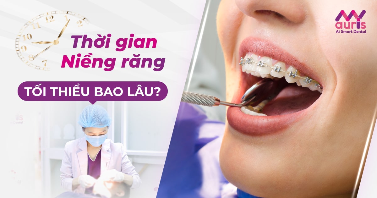 Thời gian niềng răng tối thiểu với 4 yếu tố ảnh hưởng