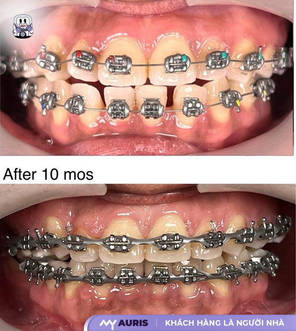 trả góp niềng răng,dịch vụ niềng răng trả góp,nha khoa niềng răng trả góp,chi phí niềng răng trả góp,giá niềng răng trả góp