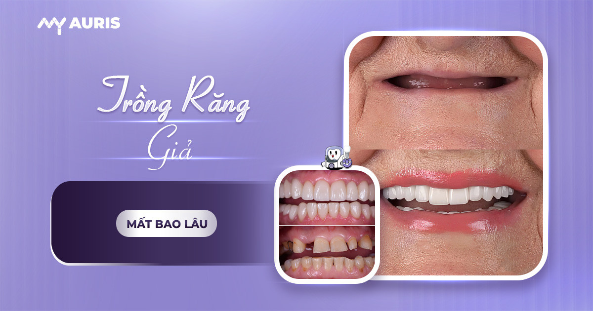 trồng răng giả mất bao lâu,làm răng giả dùng được bao lâu,trồng răng giả cả hàm,trồng răng giả được bao lâu,trồng răng hàm bao lâu