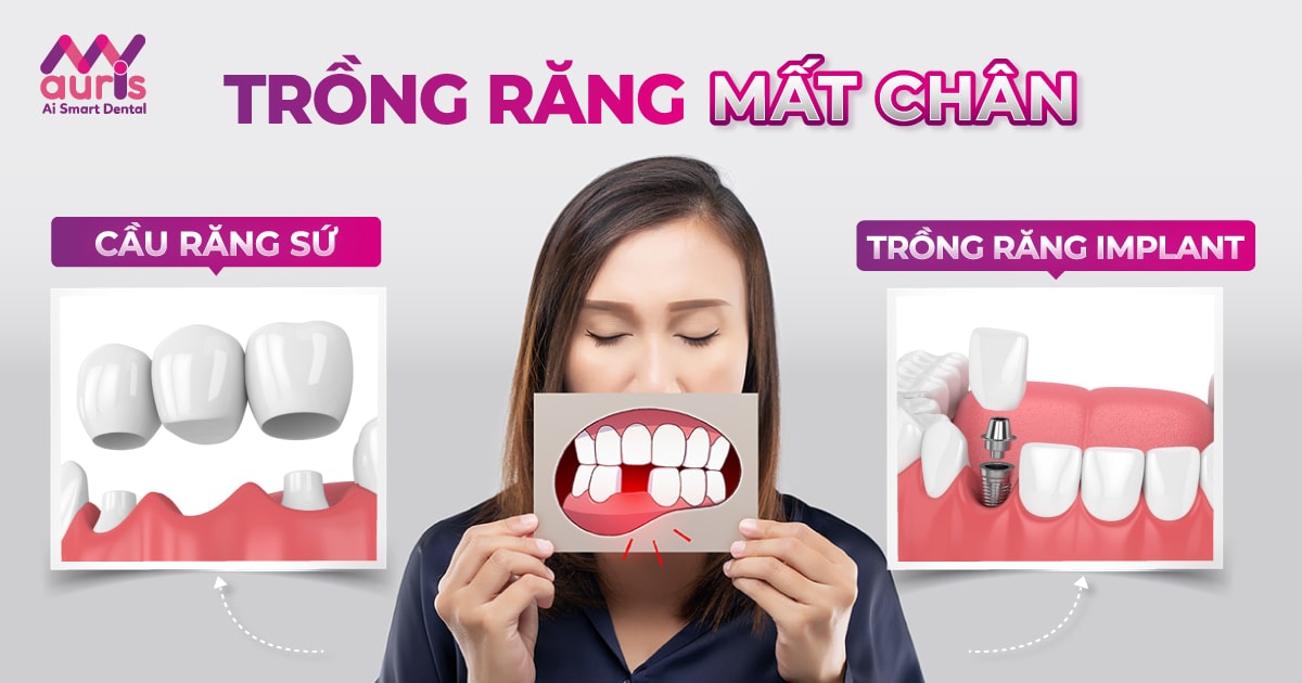 Trồng răng mất chân - Theo 2 kỹ thuật hiện đại