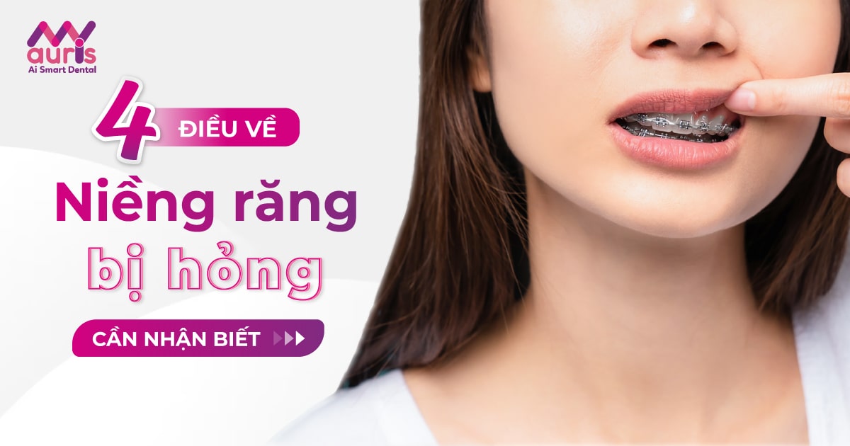 4 điều về niềng răng bị hỏng cần nhận biết