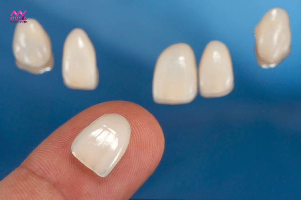 Nhược điểm của dán răng sứ 