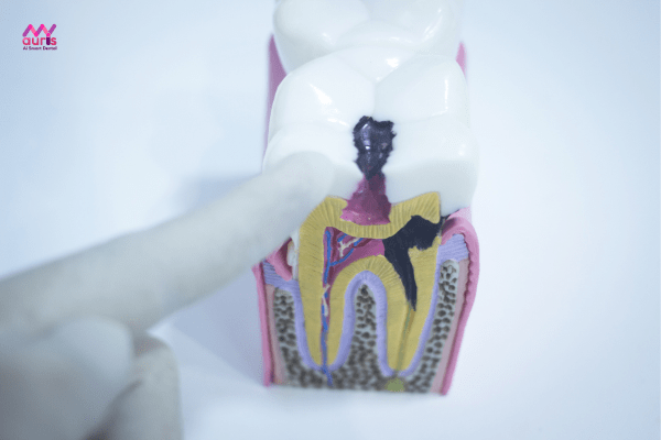 Nhiễm trùng nướu dẫn đến viêm nha chu, sâu răng 