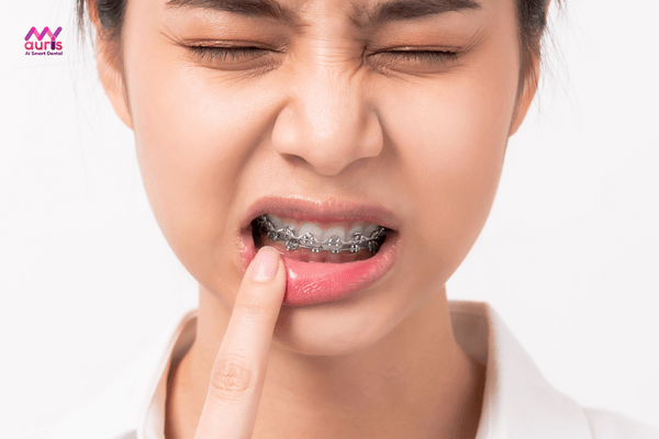Đau buốt sau khi niềng răng có sao không? 