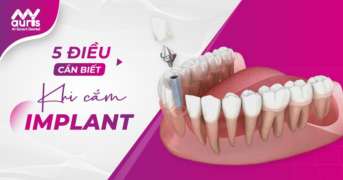 những điều cần biết khi cắm implant