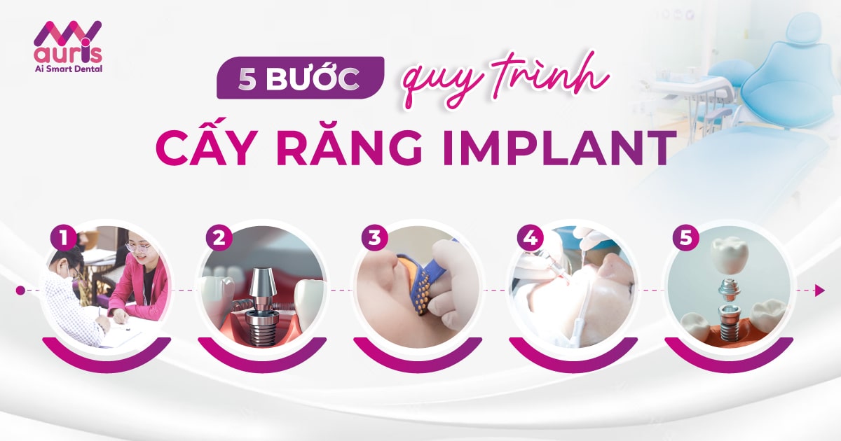 quy trình cấy răng implant