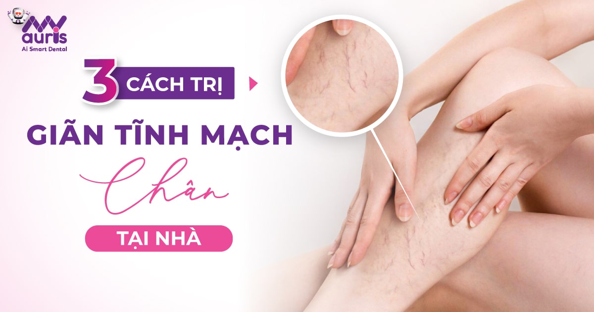 cách trị giãn tĩnh mạch chân tại nhà