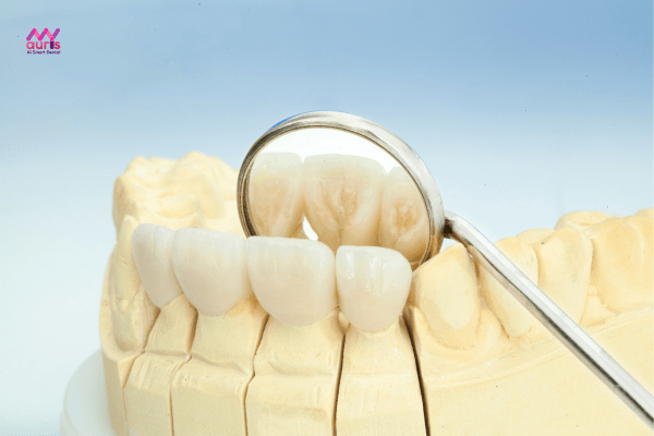 Loại răng sứ - Bọc răng sứ được bao lâu? 