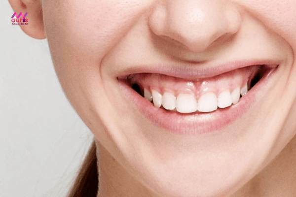 Cách nhận biết niềng răng hỏng: cười hở lợi, răng quặp vào trong 