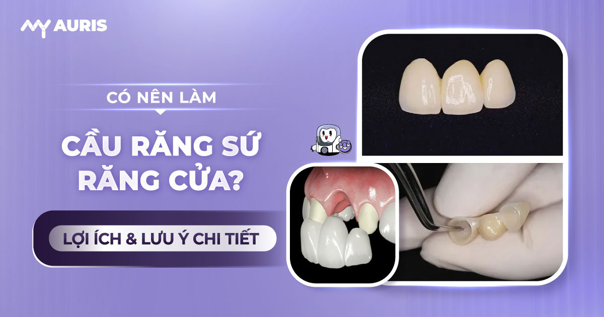 cầu răng sứ răng cửa,làm răng cửa sứ,làm răng sứ hai răng cửa,trồng răng cửa sứ