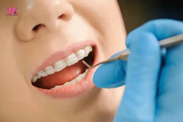 Răng có bị cứng khớp không - Có răng sứ có niềng răng được không?