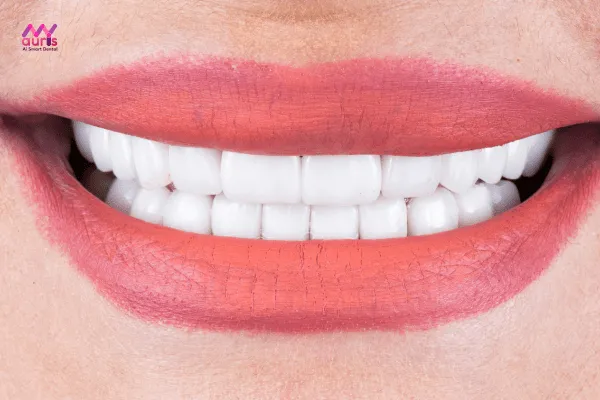 Kết quả sau khi bọc sứ - Có răng sứ có niềng răng được không?