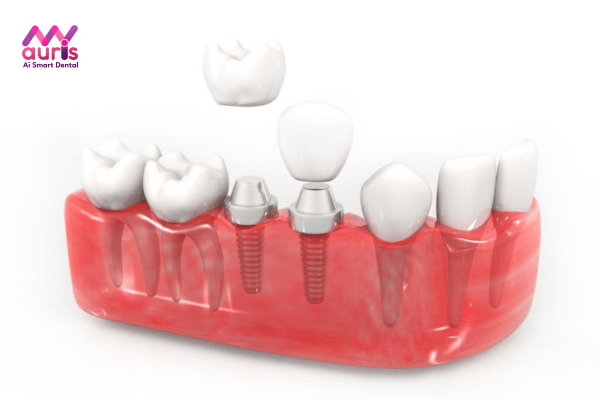 Những yếu tố làm ảnh hưởng đến giá làm răng sứ Implant