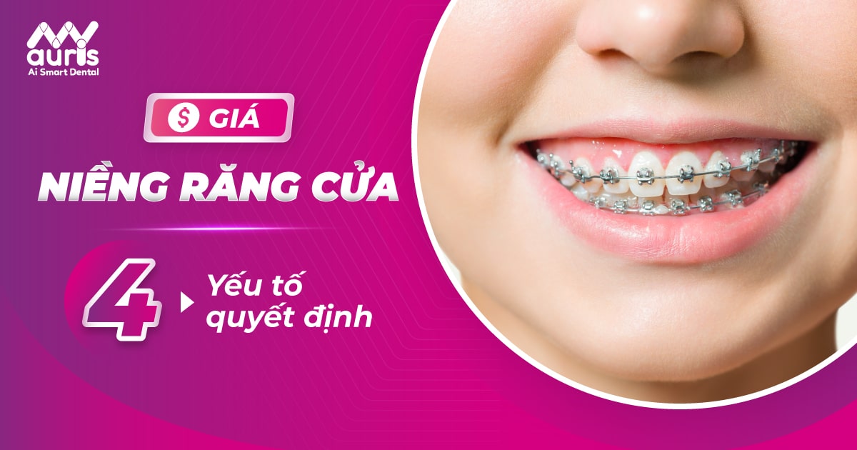 Giá niềng răng cửa - Thông qua 4 yếu tố quyết định