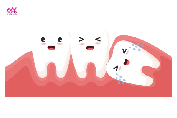 Niềng răng không nhổ răng khôn được không? 