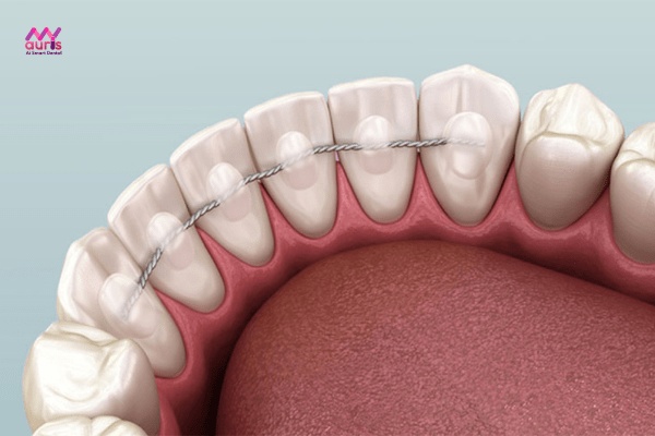Thế nào là hàm cố định sau khi niềng răng? 