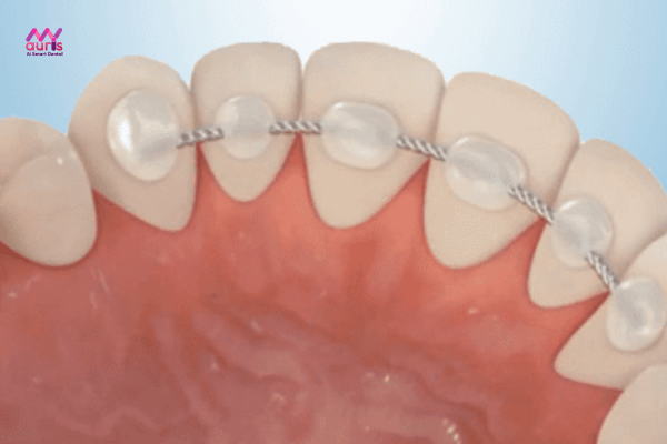 Ưu nhược điểm của hàm cố định sau khi niềng răng