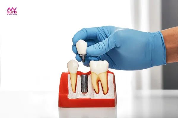 Trồng răng implant 