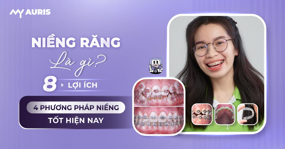 lợi ích của niềng răng