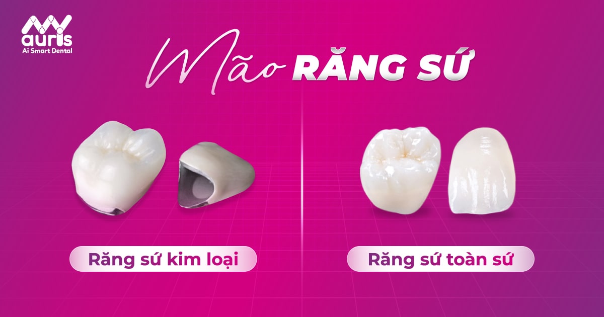 Mão răng sứ là gì? Tìm hiểu thông tin về 2 loại chính