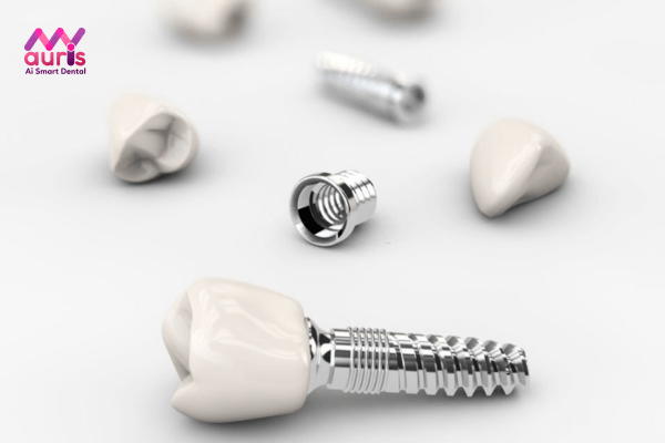 Nên trồng răng cửa loại nào? - Kỹ thuật trồng răng Implant