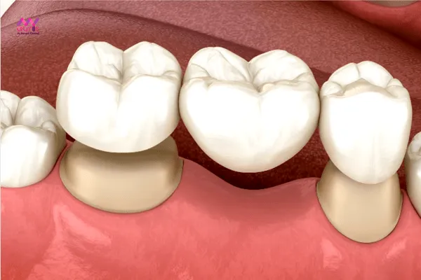 Nhổ răng bao lâu thì trồng răng giả cầu sứ? 