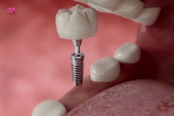 Nhổ răng bao lâu thì trồng răng giả bằng trồng răng implant? 